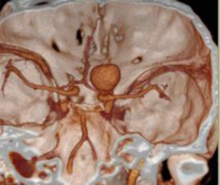 汉阳医院成功施救脑内动脉瘤濒临破裂患者